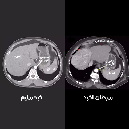 شكل سرطان الكبد